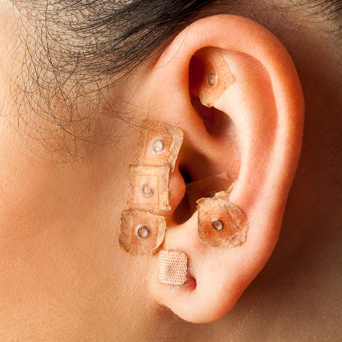 buy type of acupuncture needles at lierre