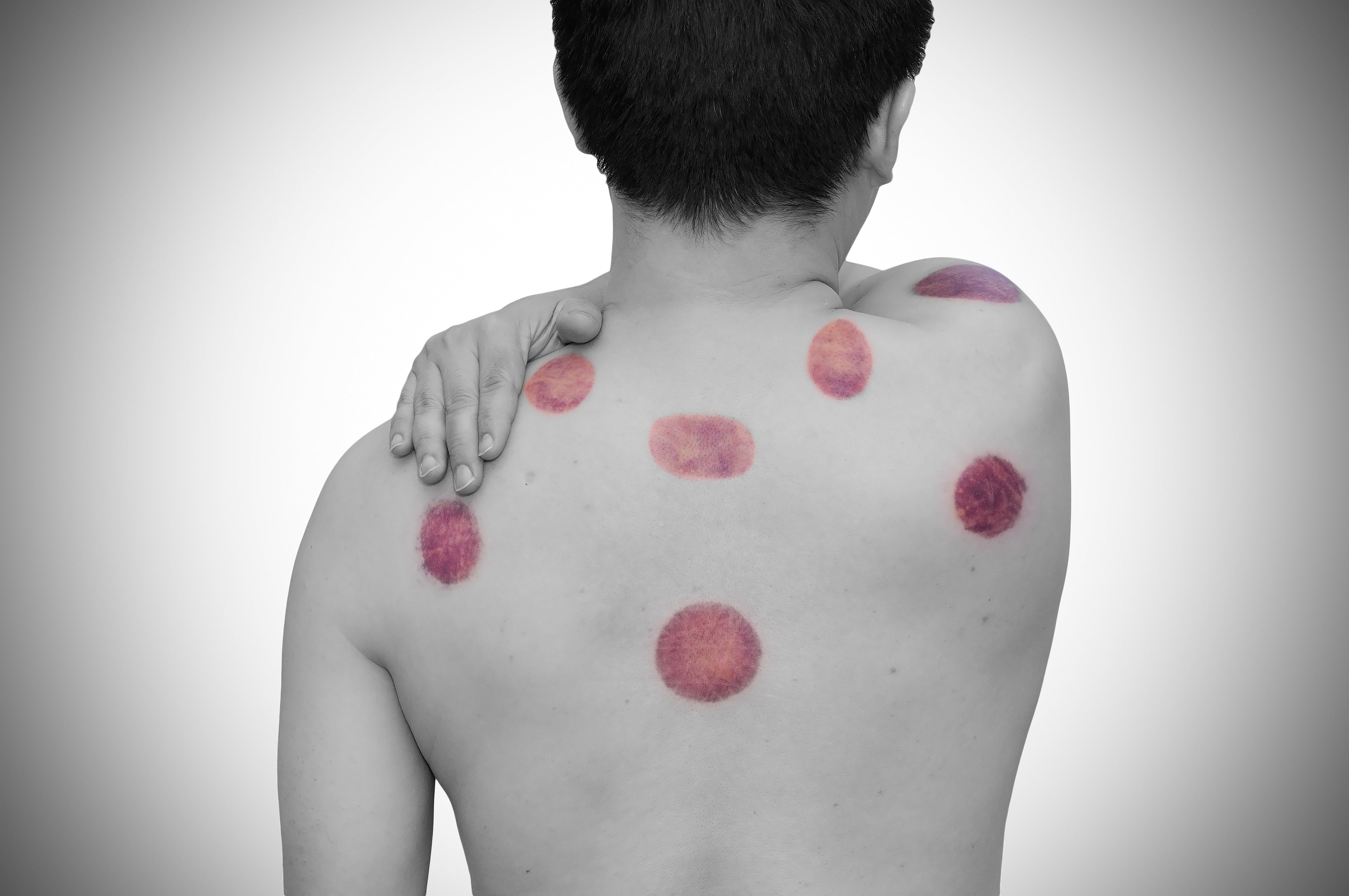 shop body cupping sets at lierre.ca