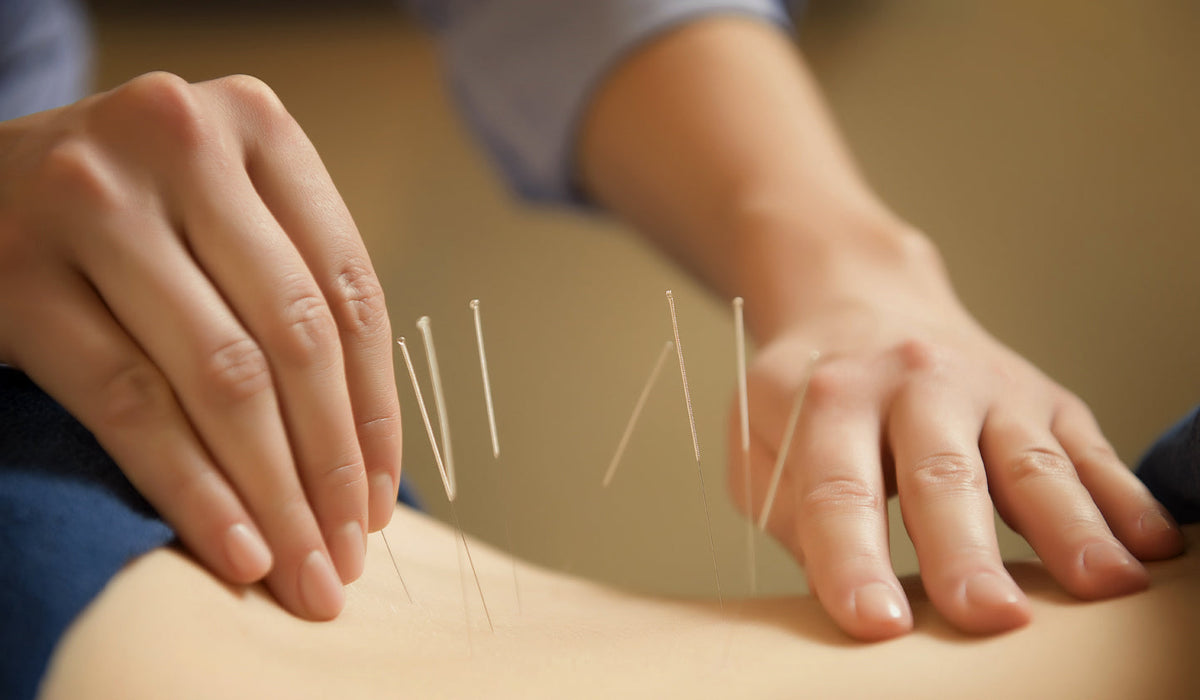 buy acupuncture #1 needles in canada at lierre.ca