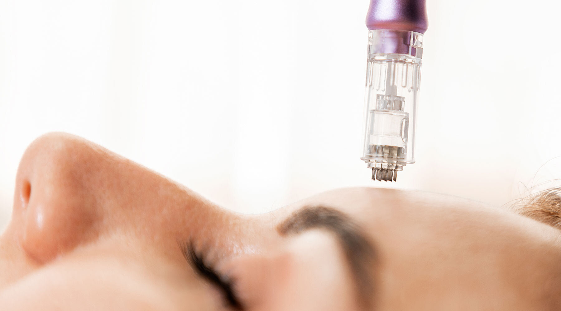 What Kind Of Acupuncture Needles Do You Use For Microneedling?