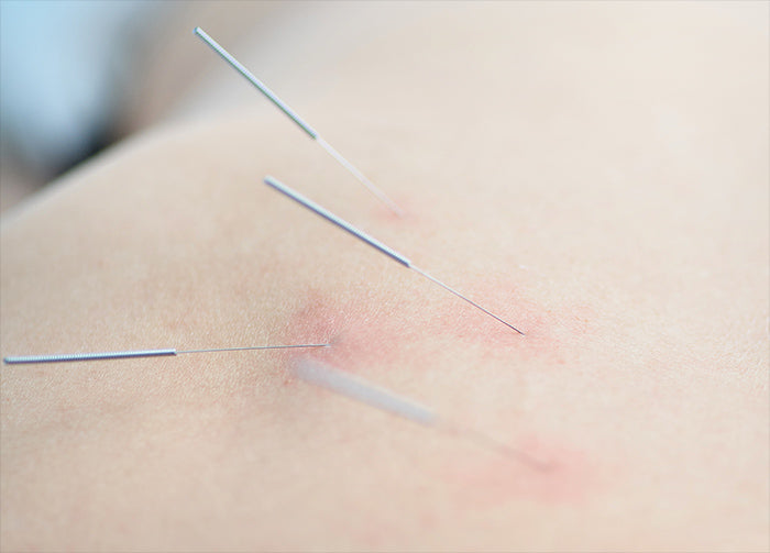 Buy acupuncture needles at lierre