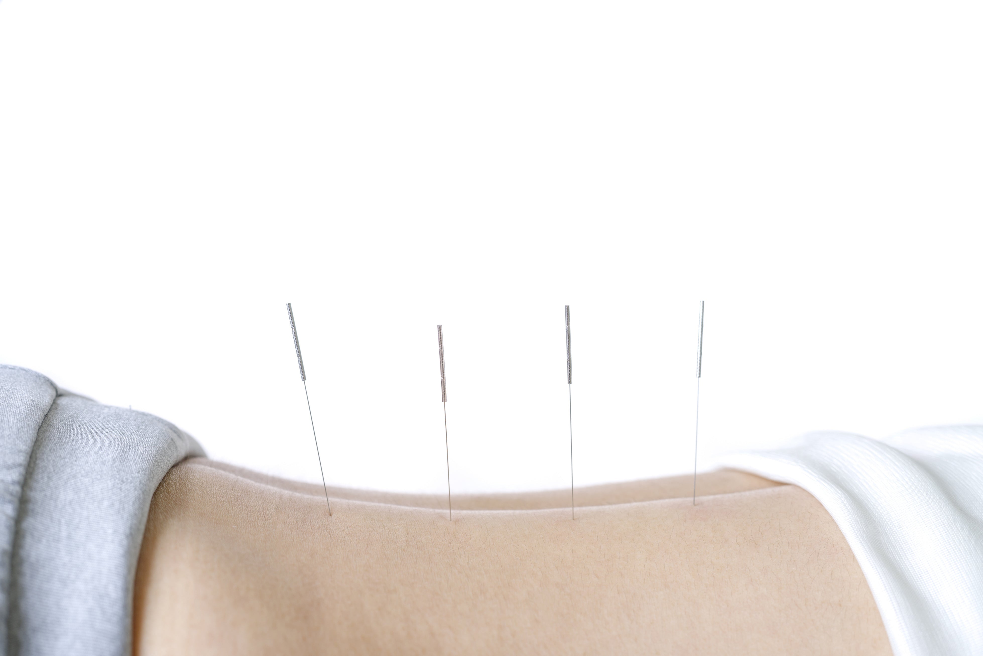 Shop professional acupuncture needles at lierre