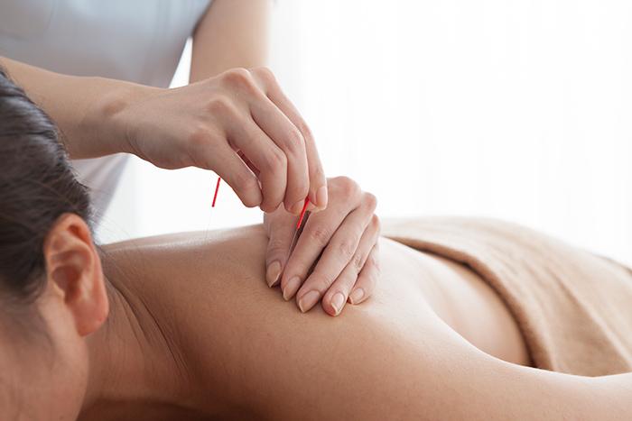 Acupuncture Therapy is not just for Pain