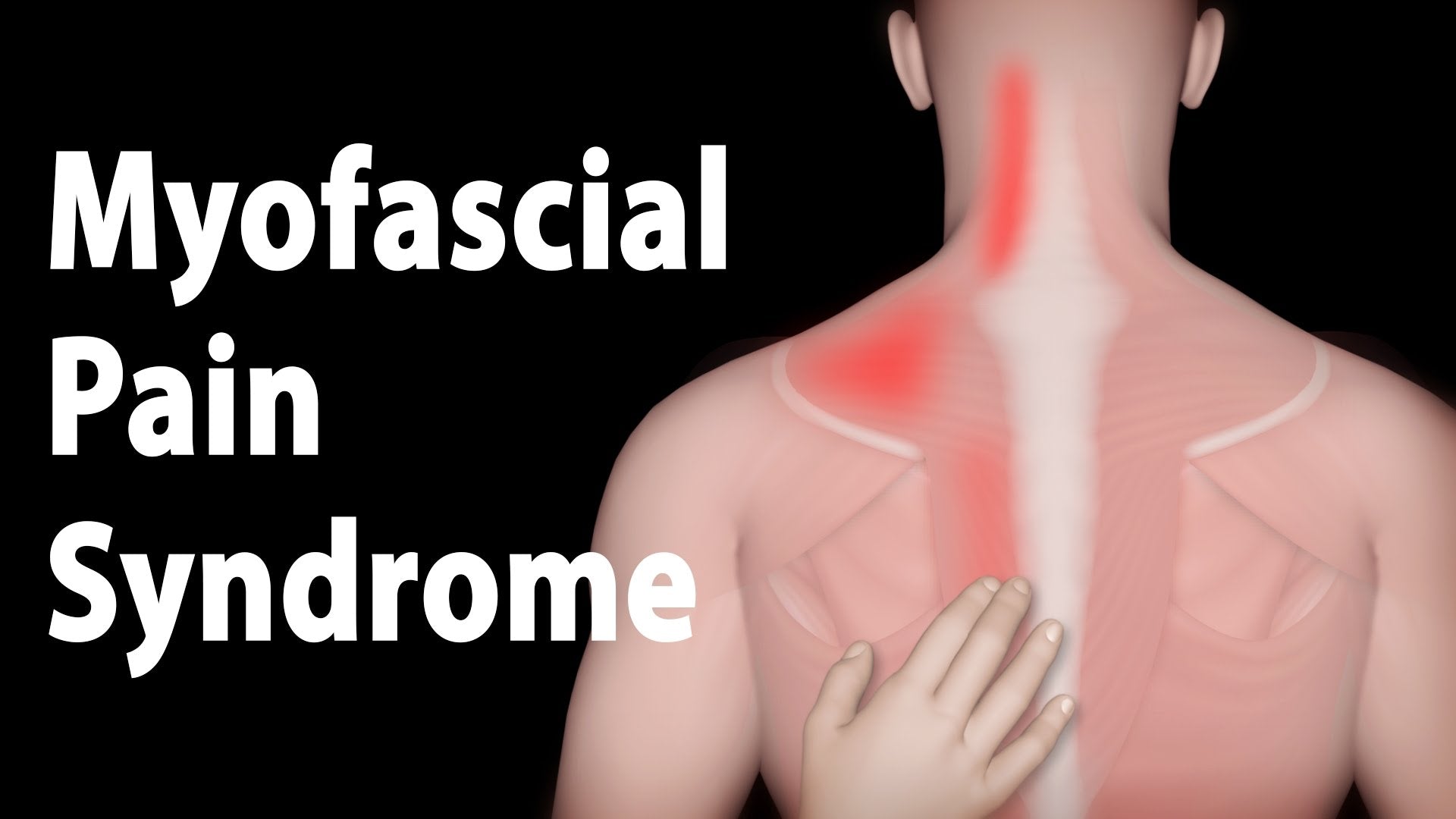 Everything You Need to Know about Myofascial Pain