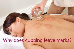 why does cupping leave marks?