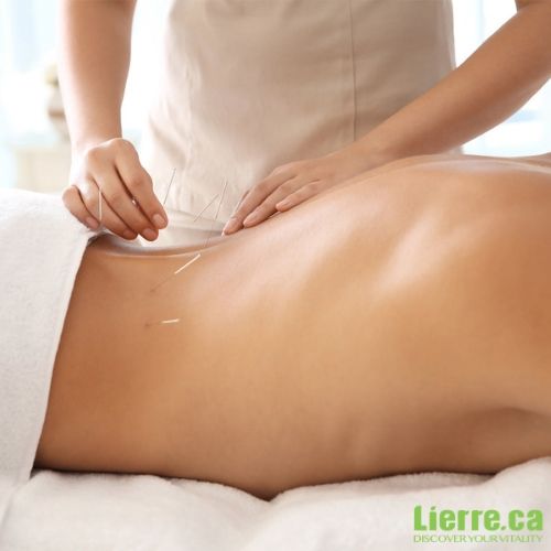 Acupuncture Needles and Supplies from Lierre Canada