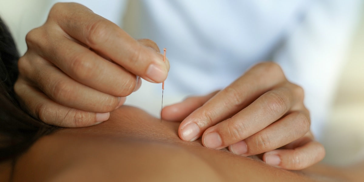 Differences Between Dry Needling and Acupuncture