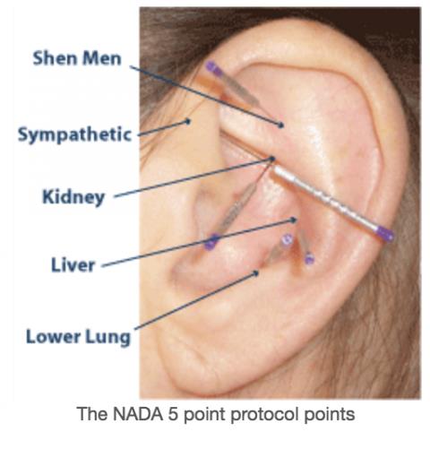 NADA acupuncture method for alcoholism