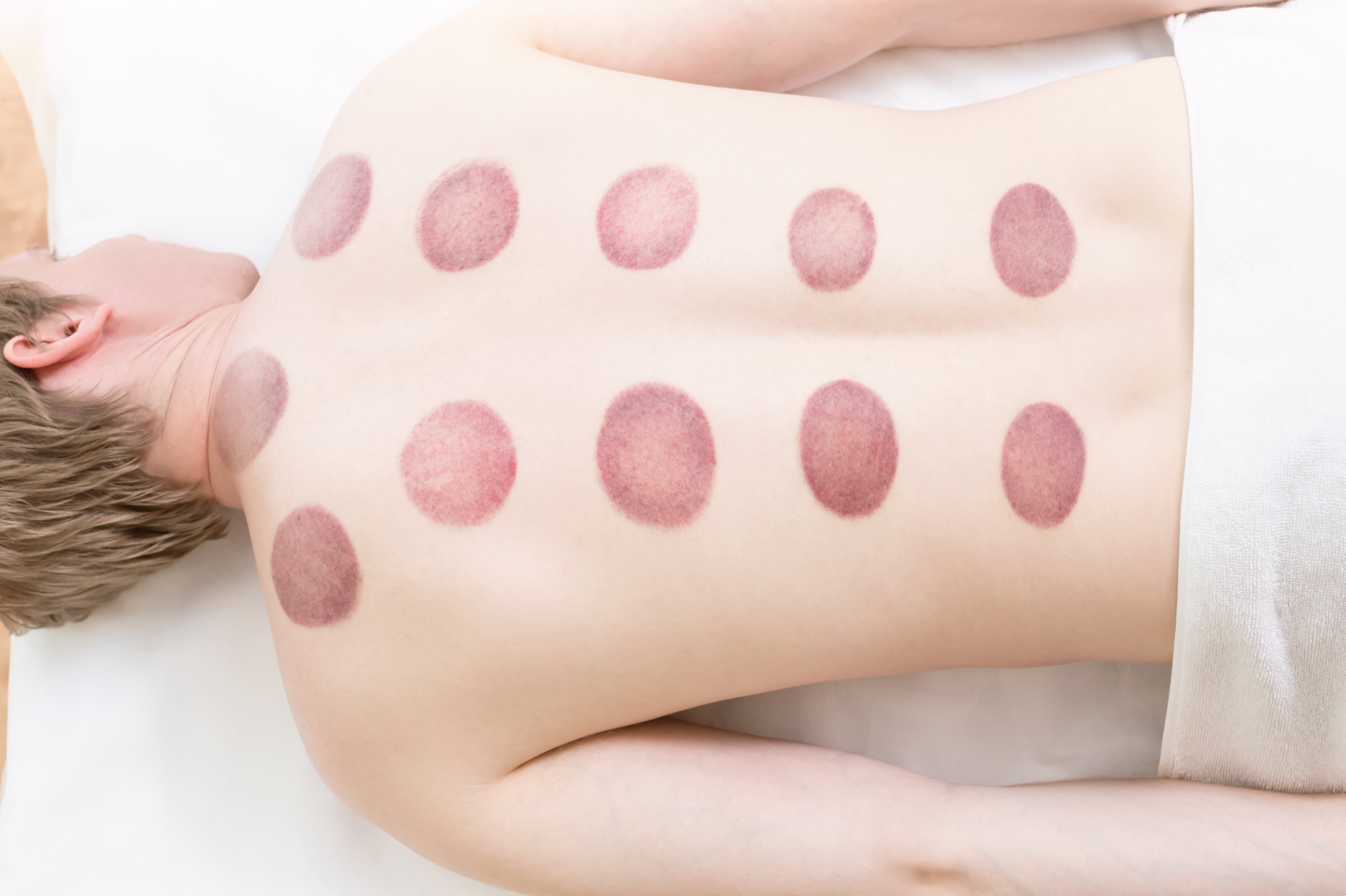 Why Does Cupping Treatment Leave Bruises? Is That Safe?