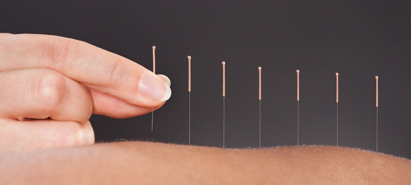 acupuncture needles from Lierre.ca