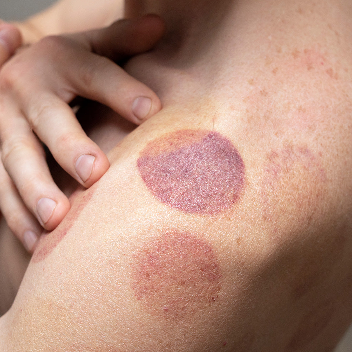Does Cupping Cause Bruising?