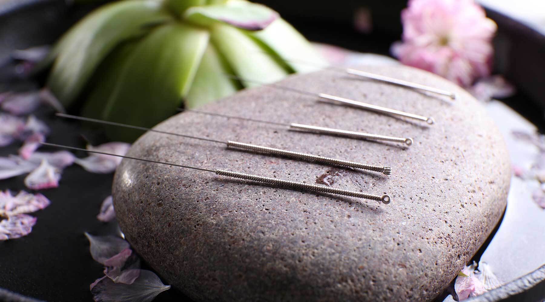 How Do You Overcome A Fear Of Acupuncture Needles?