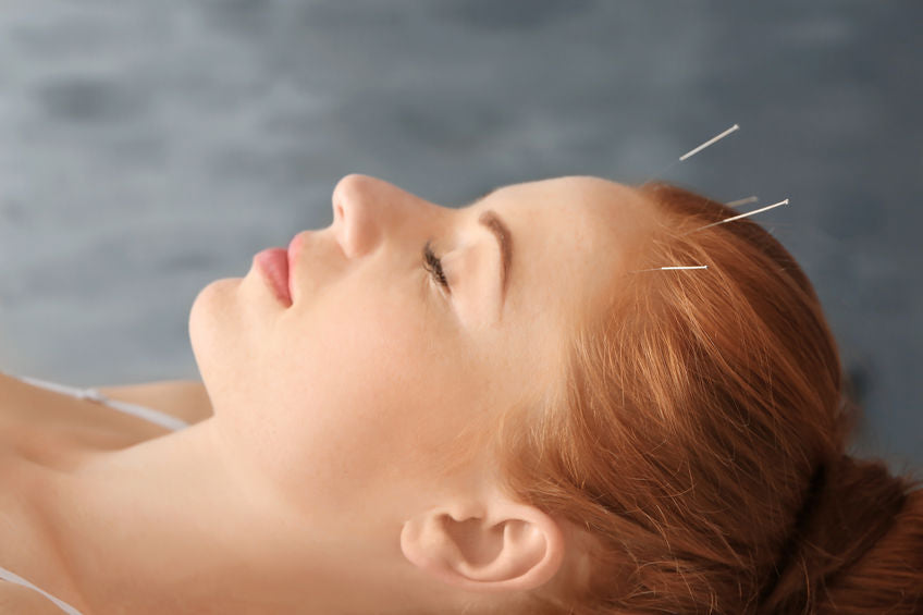 buy acupuncture needles from lierre canada