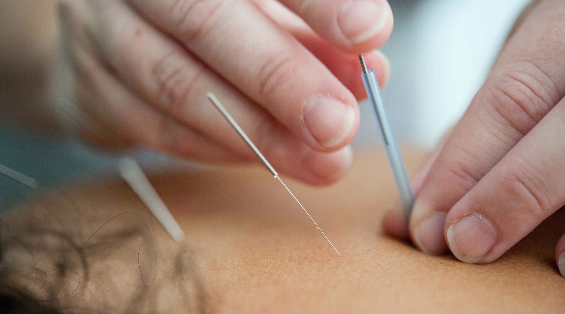 What Is the Difference Between Dry Needling and Acupuncture?