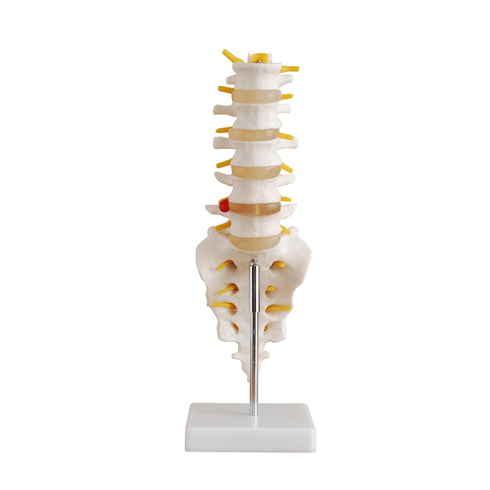 Lumbar Model: Vertebrae, Sacrum, Coccyx and Herniated Disc